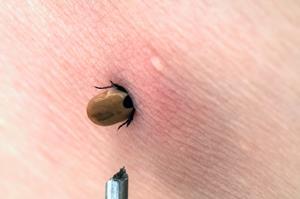Tick bites are usually harmless and produce no symptoms unless you are allergic to the tick bite or if the tick transfers a disease to you.
