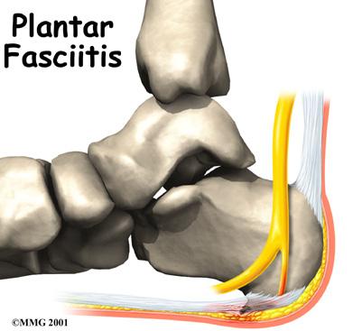 Introduction Plantar fasciitis is a painful condition affecting the bottom of the foot. It is a common cause of heel pain and is sometimes called a heel spur.