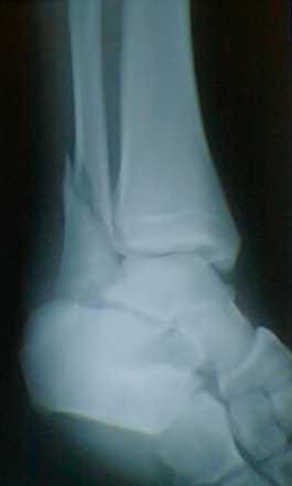 Distal Fibula fracture with associated medial deltoid ligament disruption.