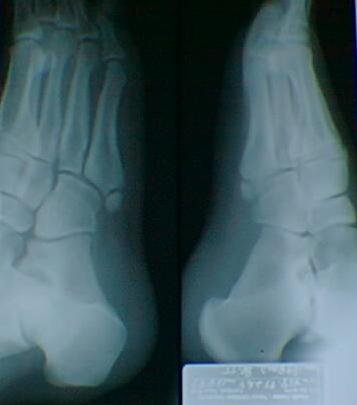 This is a ballerina type fracture of the 5th metatarsal.