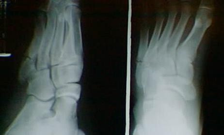 These X-Rays show a fracture of the proximal end of the 5th