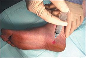Growth Factor Injections for Plantar Fasciitis: Is it for You? Primary treatment?