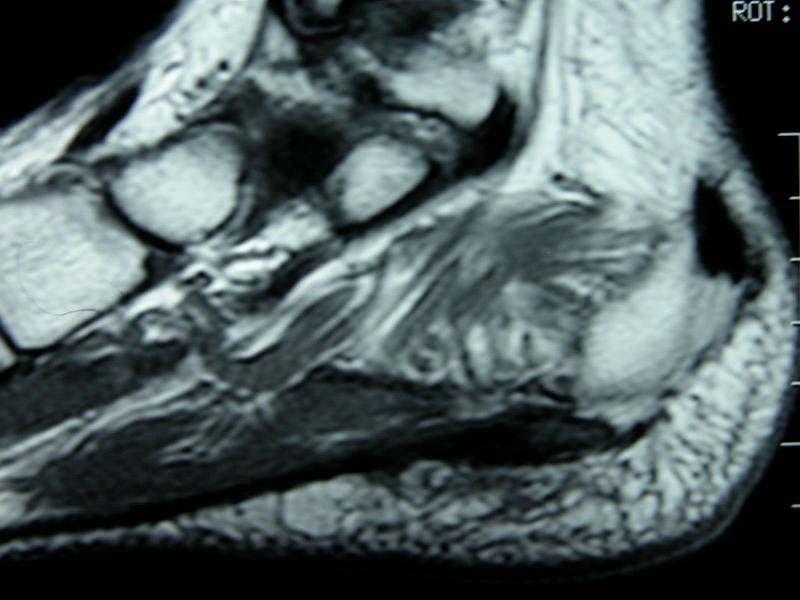 Confirming Diagnosis Abnormal fascia > 7 mm Thomas A.