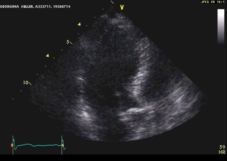 1 Eccentric LVH in 60 year-old lady at screening central arterial stiffness not