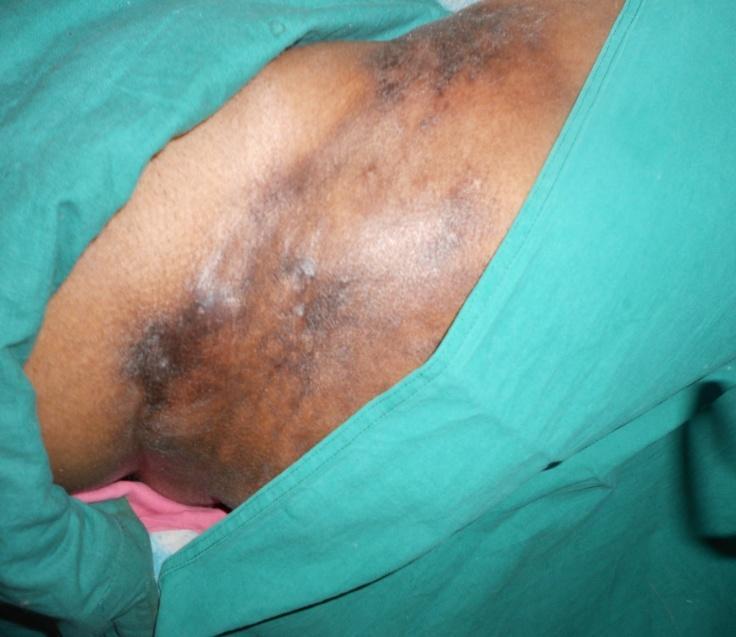 systemic lupus erythematosus lend support to morphea being an autoimmune disease [6]. Our case did not show any such association.