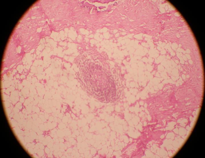 Figure 4: Histopathological slide ( H & E staining)
