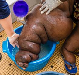About the diseases Lymphatic filariasis Lymphatic filariasis is a mosquito-transmitted disease caused by parasitic worms that damage parts of the immune
