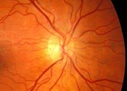 Diseases of the inner retina resulting in retinal ganglion cell