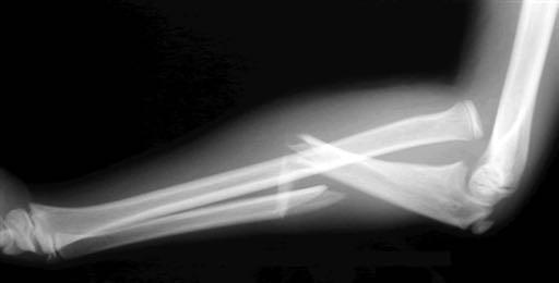 MONTEGGIA FRACTURES Proximal 1/3 ulnar fracture w/ radial head