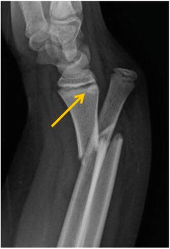 GALEAZZI FRACTURES Fracture of distal 1/3 radius with distal ulna