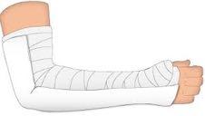 SUPRACONDYLAR FRACTURE TYPE I Posterior splint w/ elbow at 90 flexion