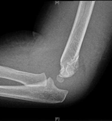 SUPRACONDYLAR FRACTURE TYPE