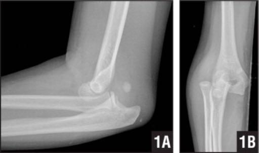 MEDIAL EPICONDYLE FRACTURES Up to 60% associated w/ elbow dislocation 15-20% of elbow dislocations result in