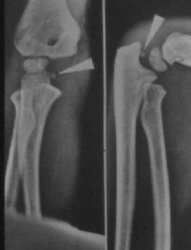MEDIAL EPICONDYLE FRACTURES TREATMENT Non-op: < 5 mm displacement Up to 4 weeks immobilization in AE
