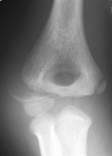 LATERAL CONDYLE FRACTURES #2 pediatric elbow fracture High risk of non-union, malunion, AVN Mechanism: