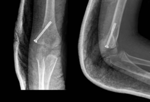 LATERAL CONDYLE FRACTURES TREATMENT Non-op if < 2 mm displacement in all views AE cast 4-6 weeks, elbow at 90º Weekly x-rays