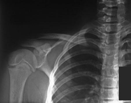 LITTLE LEAGUE SHOULDER Physis injury of proximal humerus Repeated overhead throwing causes microtrauma