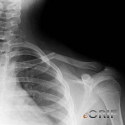 CLAVICLE FRACTURES 8-15% of pediatric fractures Mechanism: Direct blow to clavicle FOOSH Impact to lateral shoulder Treatment for uncomplicated