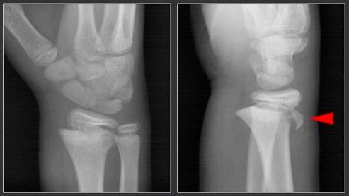 DISTAL RADIUS FRACTURES Most common fracture in pediatrics (28-30%) Metaphysis most frequent site Most do well with closed reduction if needed OR: open,