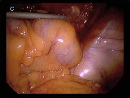 Ultrasound Obstet Gynecol 2001.