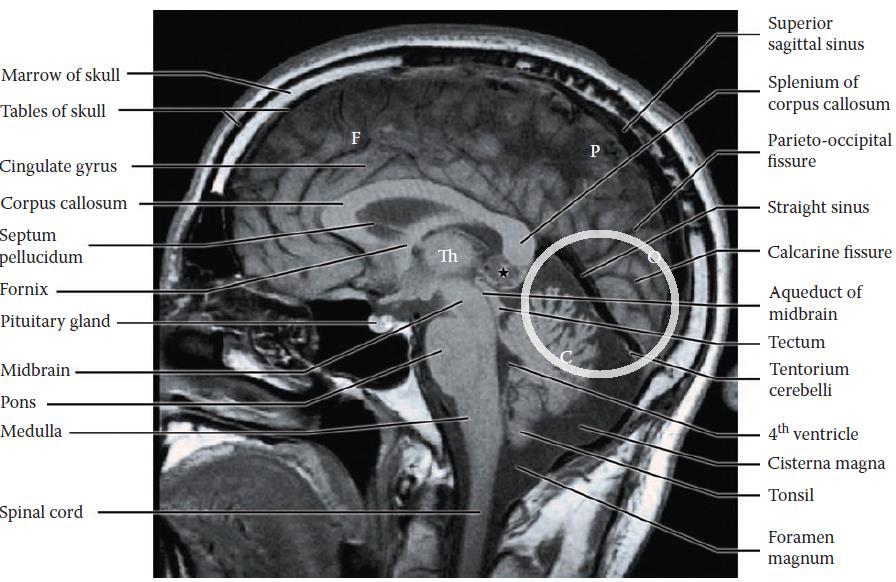 Slika 11: Sagitalni MRI posnetek z označenim tentorium cerebeli (Hendelman, 2006) Izraz supratentorialno uporabljajo zdravniki za označitev težav v enem izmed možganskih režnjev.