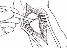 Resection of the medial eminence and adductor release is performed or should be performed in a manner that is comfortable for