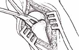 The plantar capsule of the TMT will often need to be transected as this structure limits access to the plantar joint. 2.