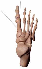 These include drilling, burring, scaling, and picking. 4. POSITIONING & TEMPORARY FIXATION OF THE FIRST RAY 1. The position of the first metatarsal is balanced in all three planes: A.
