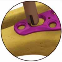 CAUTION: Improper drilling of Delta Hole may prevent the screw from engaging the plate properly and
