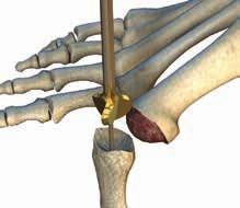 MTP Arthrodesis Surgical Approach A dorsal longitudinal or dorso-medial incision is the recommended surgical approach, as it provides the best exposure for plating of the MTP joint.