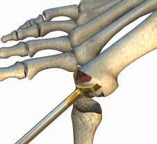 Start the incision just proximal to the interphalangeal joint and extend it over the dorsum of the MTP joint, medial to the Extensor Hallucis Longus (EHL) tendon.