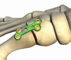Provisional fixation is achieved by placing the temporary fixation pins proximal and distal to the joint in the temporary fixation holes or any plate screw