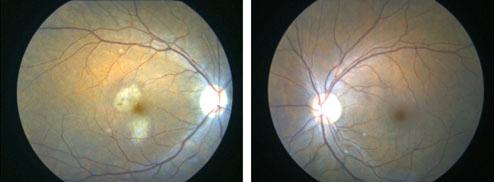 In addition to the cotton wool spots, there are two white lesions in the macula.