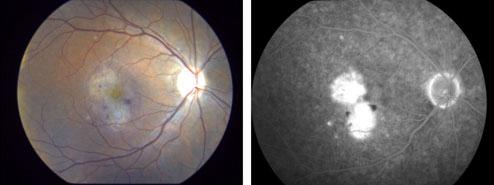 Fluorescein angiography shows leakage from the lesion in the right eye. Figure 2.