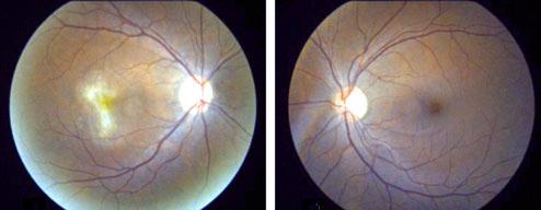 SM Bazarah et al. Choroidal neovascularization with interferon associated retinopathy 175 Figure 4.