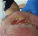 Previous wound care treatment: Split-thickness skin graft, topical treatment included silver foam dressing, and honey hydrocolloid dressing. Day 1: Onset of Care Wound Dimensions: 3.0 cm X 1.5 cm X 0.