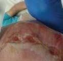 Cleansed wound with normal saline solution, applied collagen dermal template with ECM,* and a border foam dressing to cover.