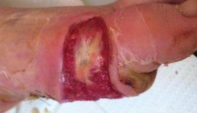 CASE STUDY 20 Diabetic Foot Ulcer Left First Metatarsal Patient: 51 year-old male with diabetic foot ulcer Diabetic with abscess on left first