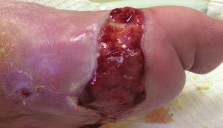 0 cm x 0.2 cm Wound description: Wound continues to reduce in size Case provided by: Dr.