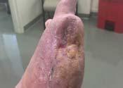 CECM was used prior to skin graft placement and again two weeks after skin graft to complete healing. Dressings were removed prior to HBOT weekly therapy.