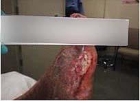 This form of treatment showed favorable results in preparation of these wounds with exposed tendon and/or bone.