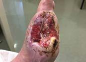 9,10 Tendon and/or bone exposure in a wound increases the complexity and provides challenges in healing the wound.