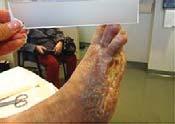 Methods: These cases involve high risk diabetic patients with diabetic foot ulcers (DFUs) that were Wagner 3 or greater, with tendons and/or bone exposed.