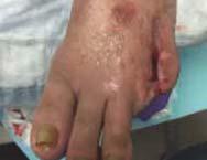 debridement and partial 1st metatarsal amputation Case Study 2: Diabetic Foot Ulcer- Wet Gangrene Patient: 70 year-old female hypertension, end-stage renal disease and on hemodialysis Case Study 3:
