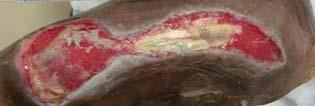 The use of an ovine collagen extracellular matrix dressing in conjunction with negative pressure wound therapy in the management of chronic diabetic foot ulcers.