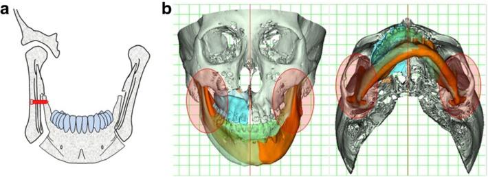 With regard to SSRO, mediolateral displacement of the posterior portion of the distal tooth-bearing segment impinges on the condylar proximal segment, resulting in a large osteotomy gap between them