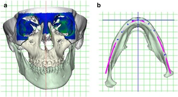 Fushima and Kobayashi Maxillofacial Plastic and Reconstructive Surgery (2016) 38:13 Page 6 of 12 Fig. 8 Reference coordinate system for 3D diagnosis. a Cranial global coordinates.