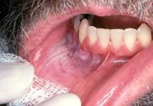 Image courtesy of the Centers for Disease Control and Prevention / Rick Ward HEALTH CONSEQUENCES of SMOKELESS TOBACCO USE Periodontal effects Gingival recession Bone attachment loss Dental caries