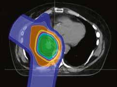 THE POTENTIAL ADVANTAGES OF PROTON THERAPY A more effective treatment due to the increased dose deposited inside the tumor and the radio-biological effect of protons, which is superior to that of