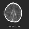 with intracranial